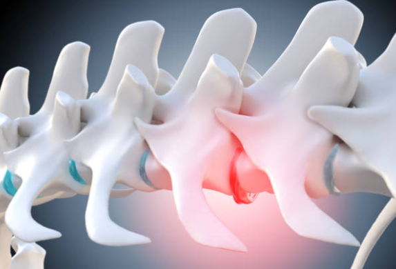 Degenerative Disc Disease