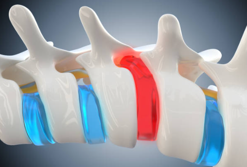 Herniated Discs