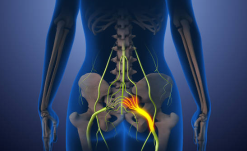 Sciatica