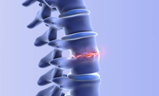 Spinal Stenosis